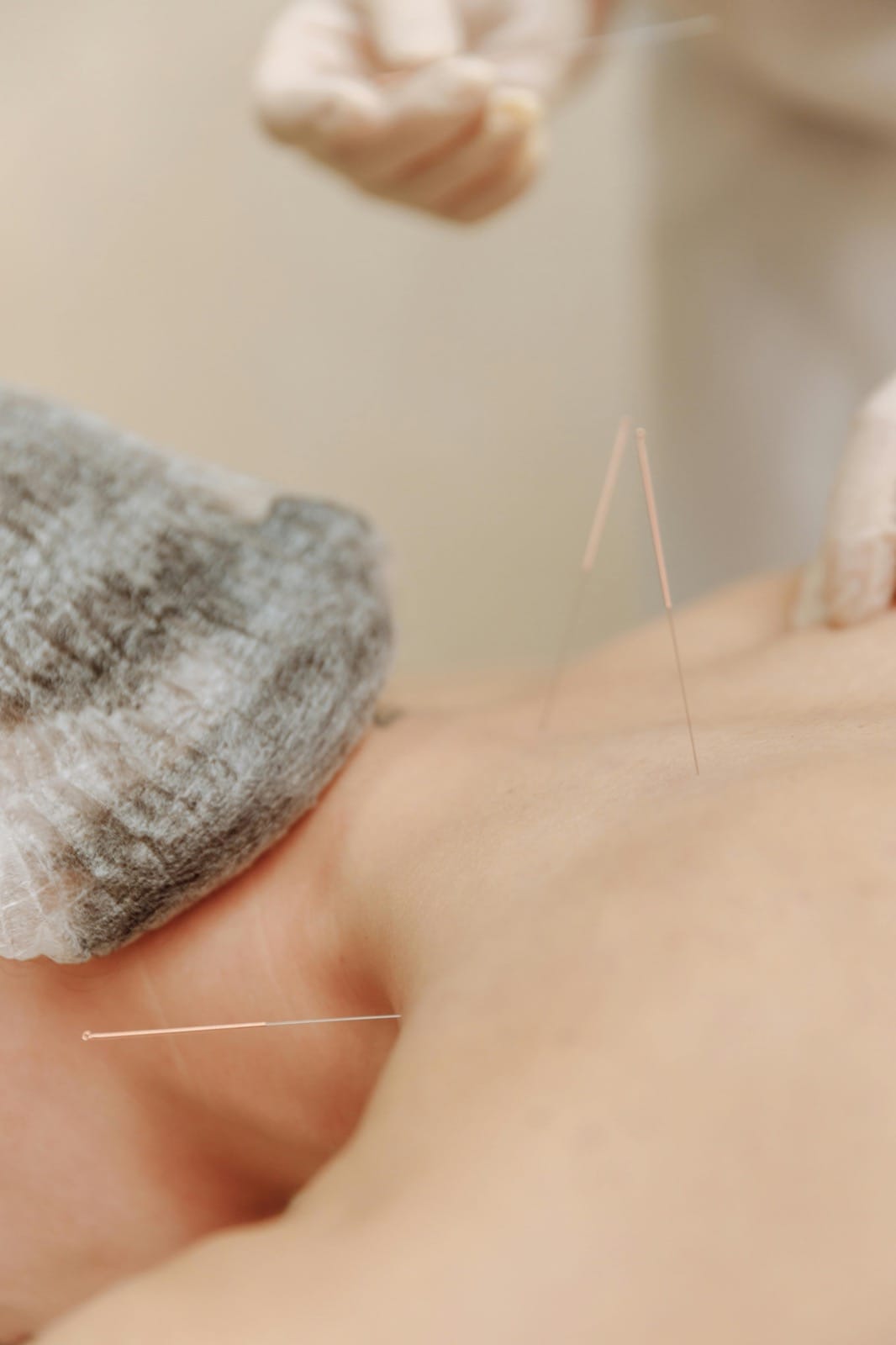 Dry Needling For Neck Pain