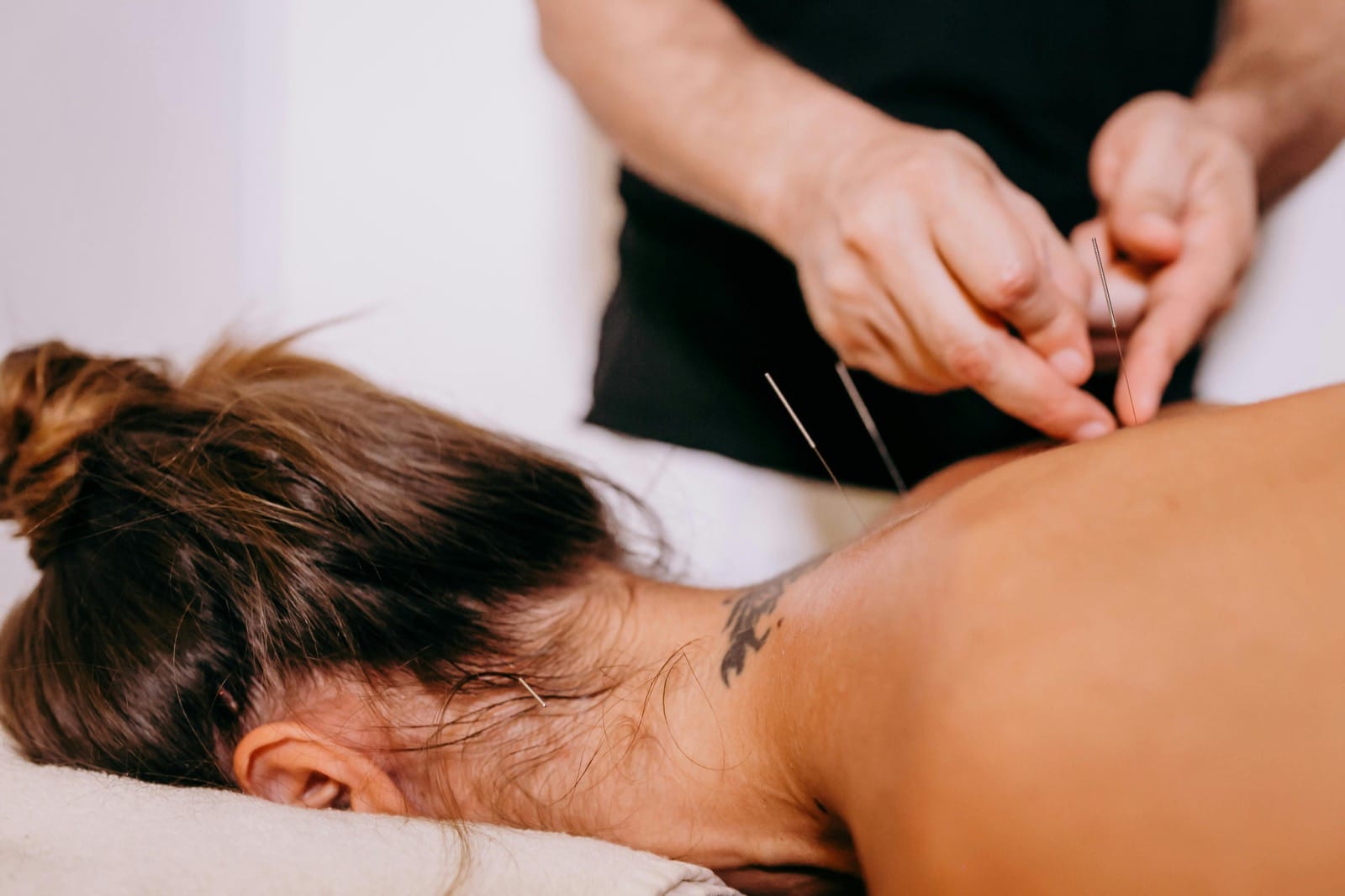 Dry Needling Sydney